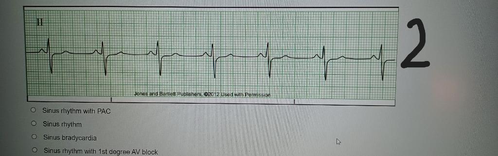 Solved Sinus rhythm with PAC Sinus rhythm Sinus bradycardia | Chegg.com