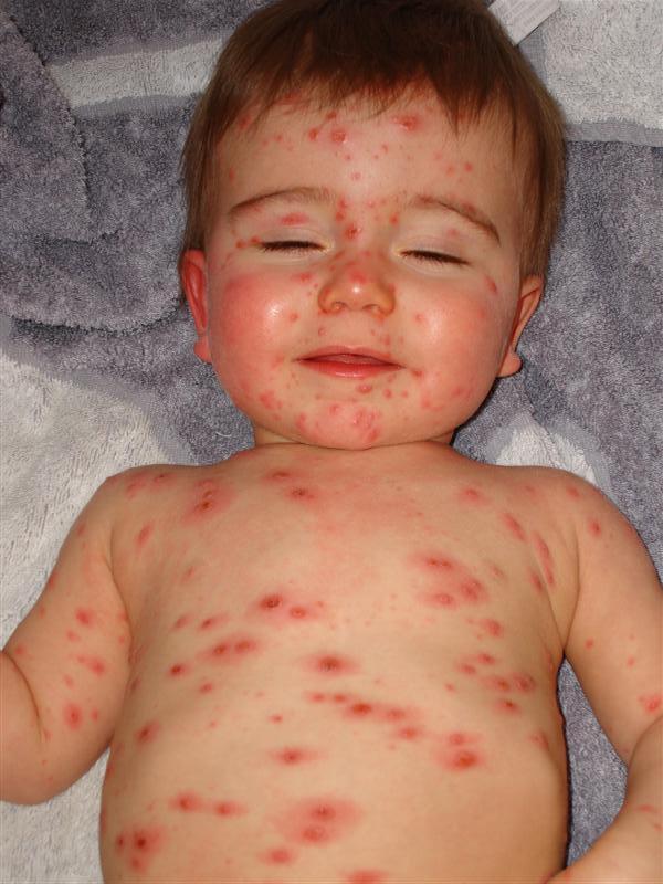 Dermatologie Flashcards Chegg Com Dermatologie Flashcards Chegg Com