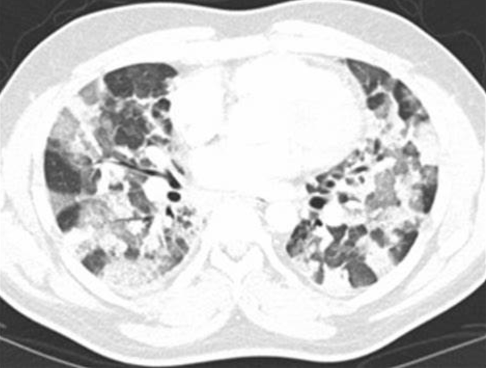 Chest Rads Tk Flashcards Chegg Com