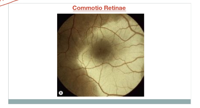 commotio retinae treatment