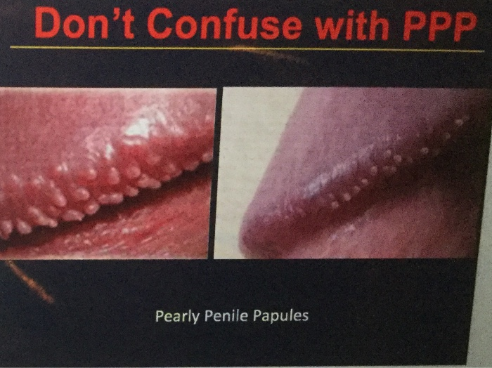pearly penile papules vs genital warts