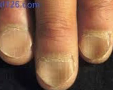 Nail Conditions Flashcards Chegg Com