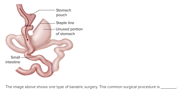 The image above shows one type of bariatric surgery. This common surgical procedure is