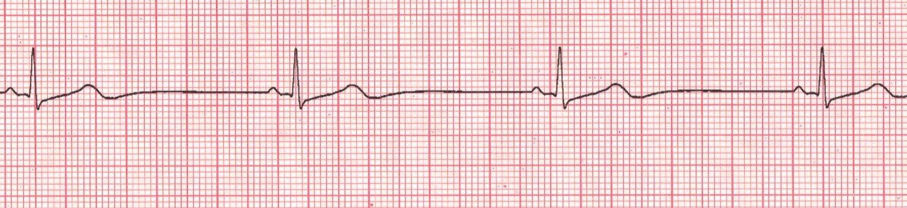 An Tech 4 Ecg Stuff Cont Flashcards Chegg Com