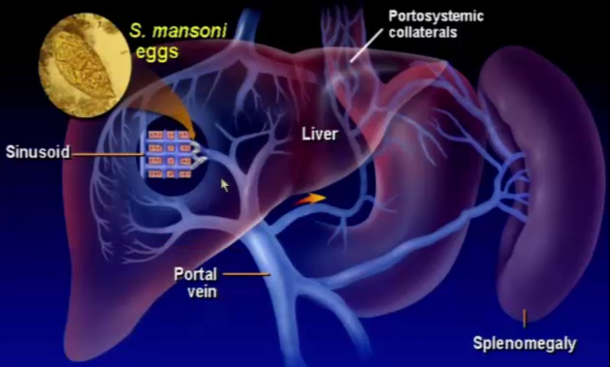 coronary vein portal hypertension