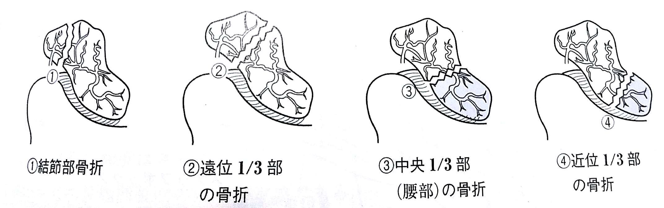 肘 手の骨折脱臼 Flashcards Chegg Com