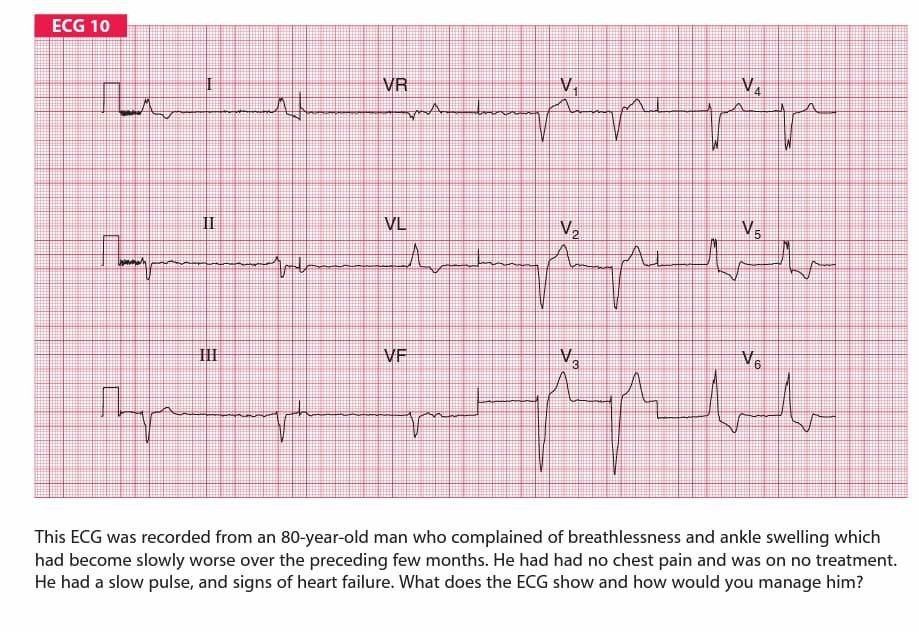 Solved ECG 10 V. VR ma ir var N II VL V2. V5 A m. VE VE 6 hy | Chegg.com