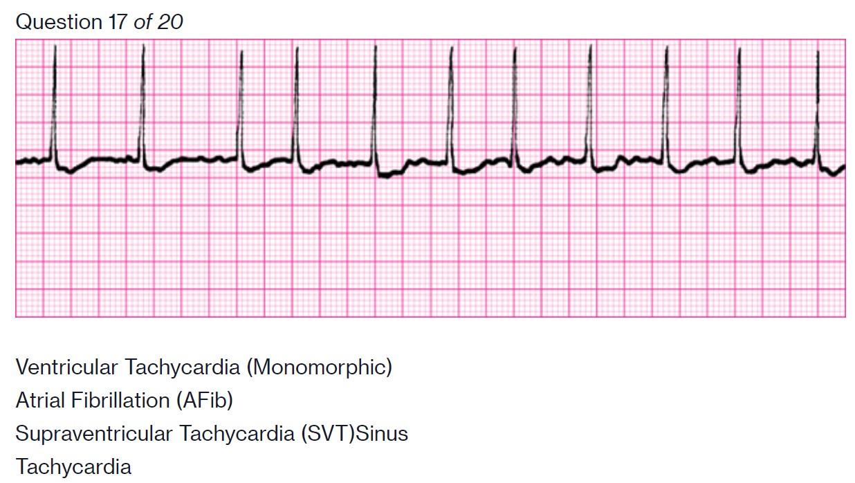 Solved Question 17 of 20 Ventricular Tachycardia | Chegg.com