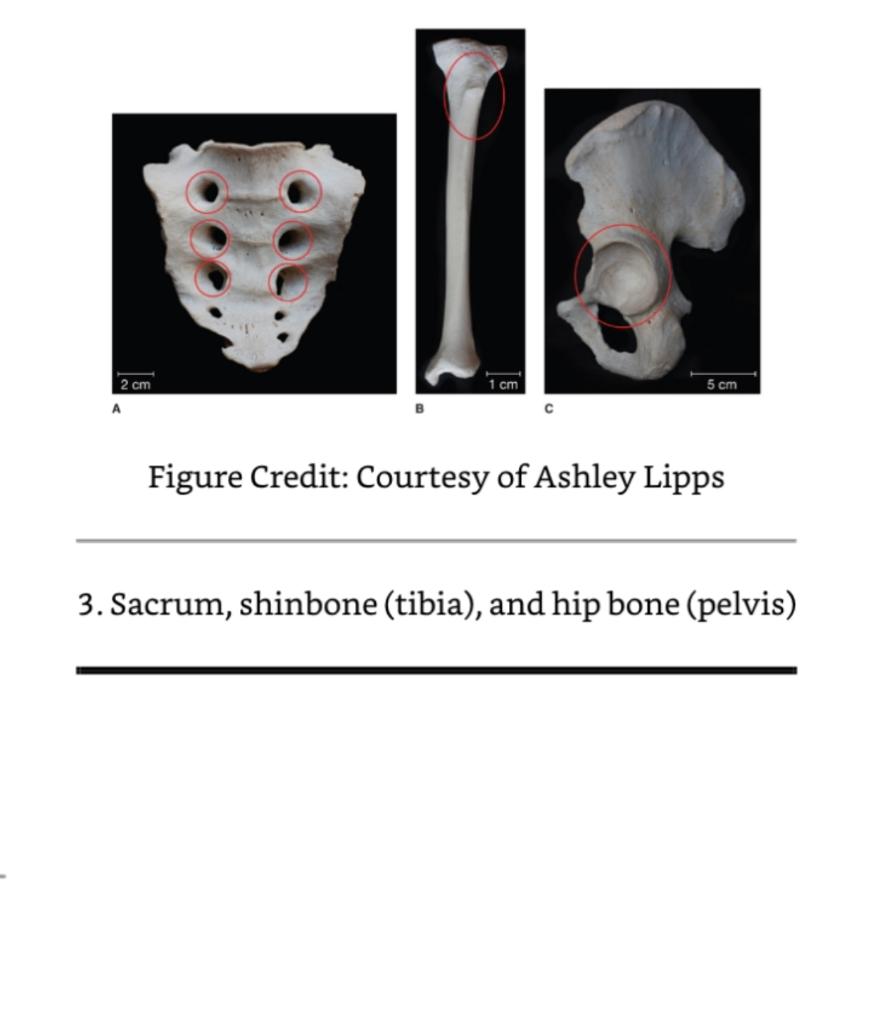 Anatomy, Bony Pelvis and Lower Limb, Hip Joint - Clinical - StoryMD