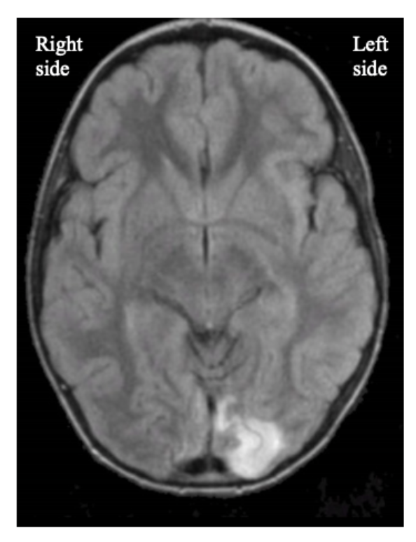 Solved What Does This MRI Show? What Do The Light And Dark | Chegg.com