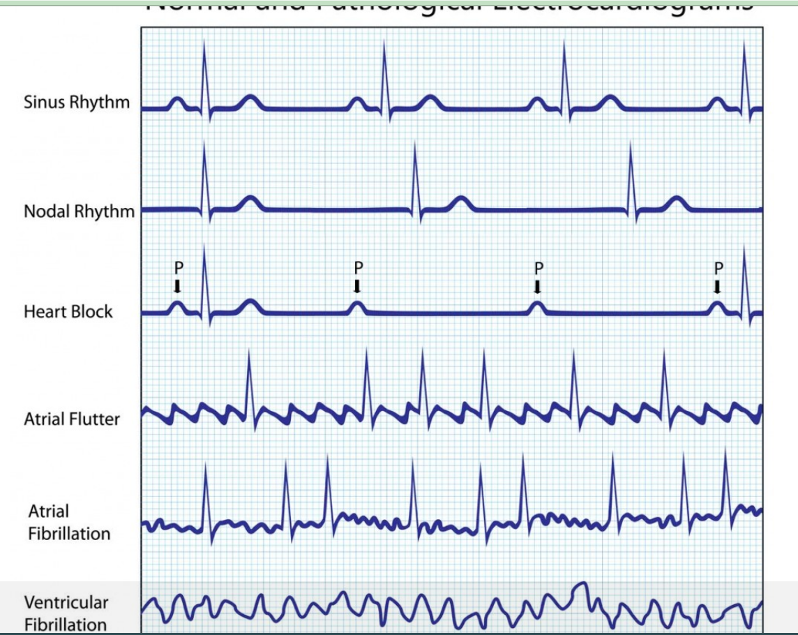 normal ecg reading