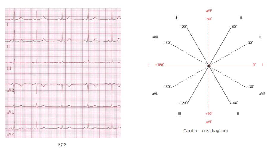 Solved I don't understand how to determine whether the ECG