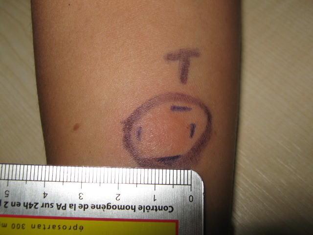 Solved Pathology of the Mantoux (Tuberculin) | Chegg.com