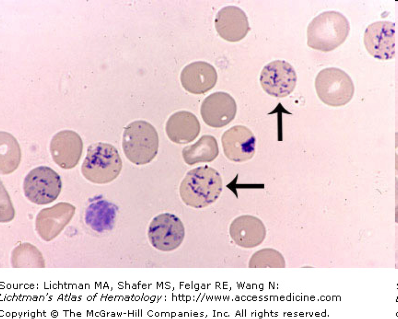 reticulocyte vs heinz body