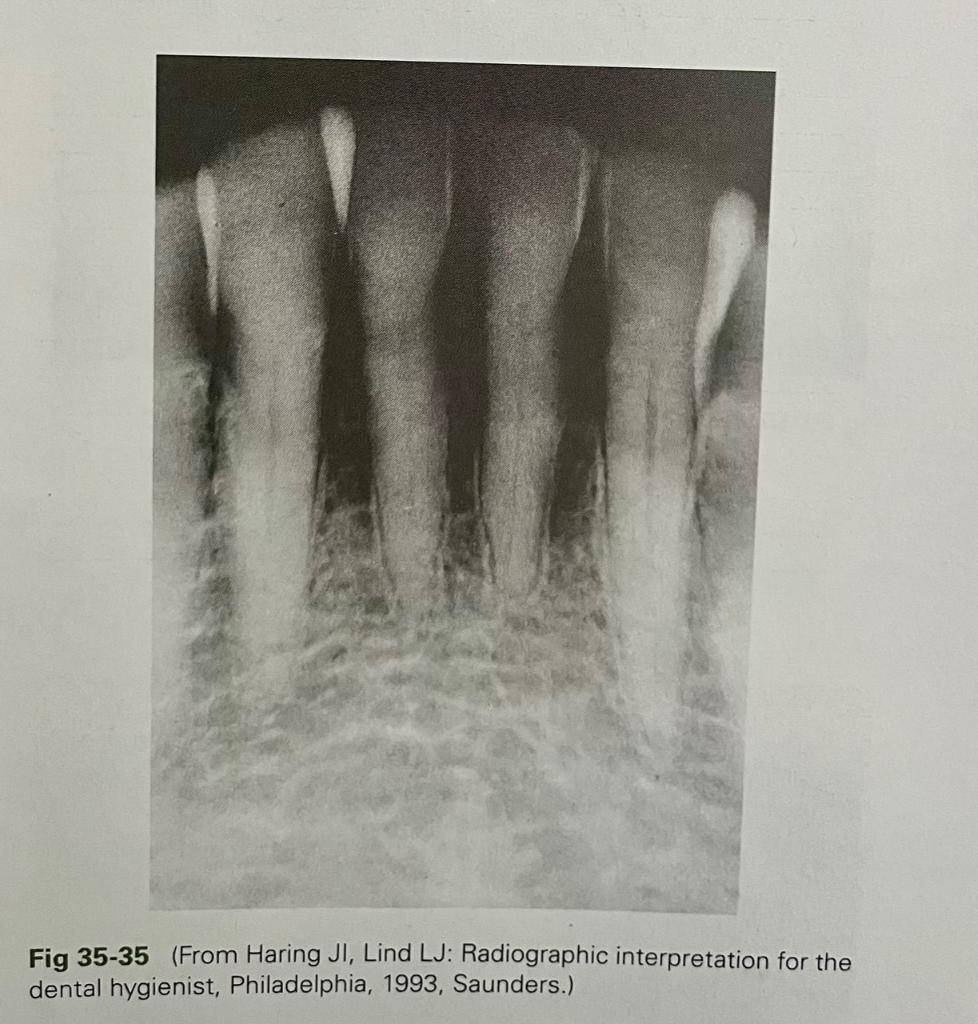 Fig 35-35 (From Haring JI, Lind LJ: Radiographic interpretation for the dental hygienist, Philadelphia, 1993, Saunders.)