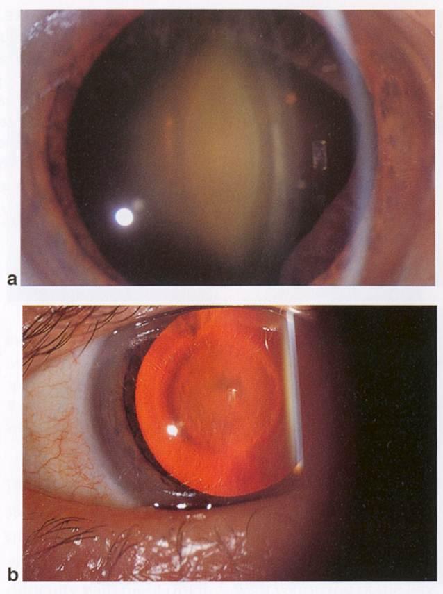 Oil Droplet Cataract Oil Droplet Cataract