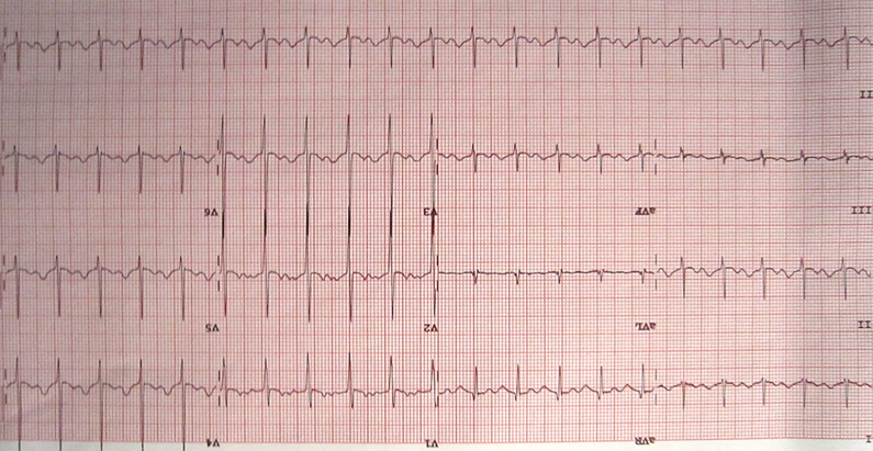 Exercise ECG Resting ECG Using the bottom | Chegg.com