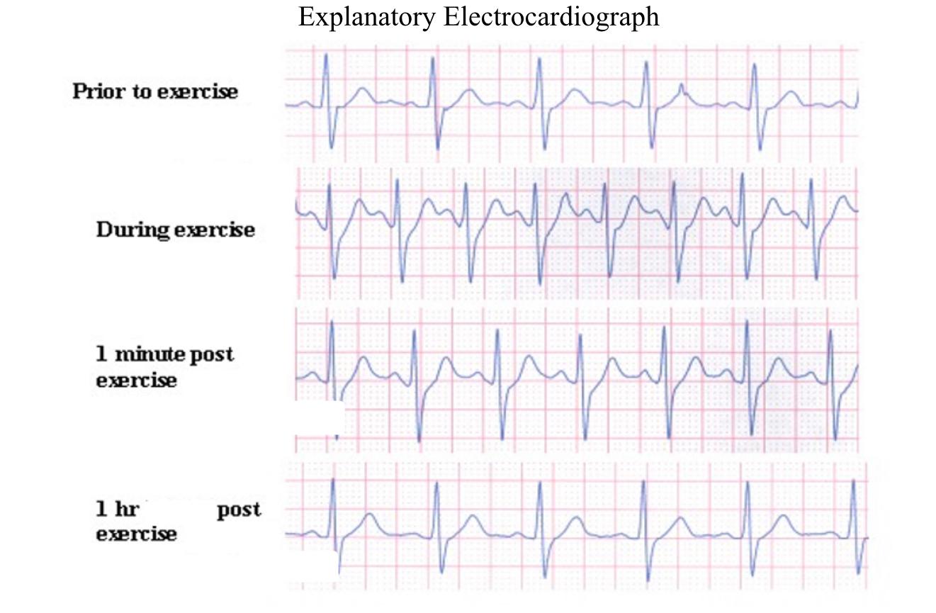 Solved Explanatory Electrocardiograph Prior to exercise | Chegg.com