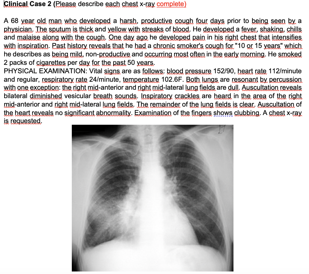 Solved Describe the chest xray What radiological pattern is