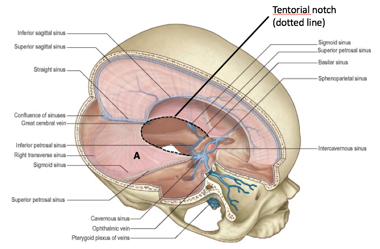 tentorial notch