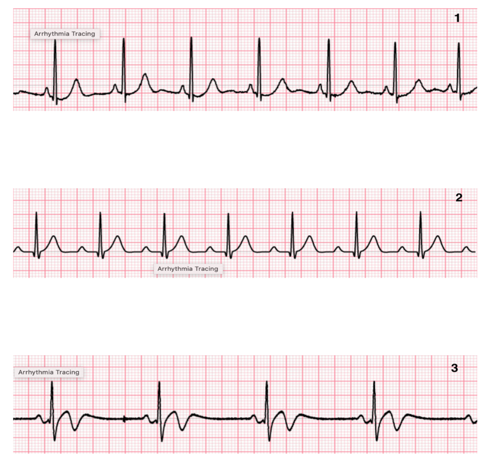 Solved 1 Arrhythmia Tracing Indentatem 2 hehehehehehehe | Chegg.com