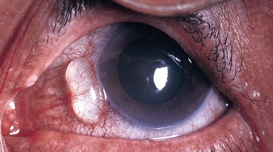 Conjunctival Retention Cyst