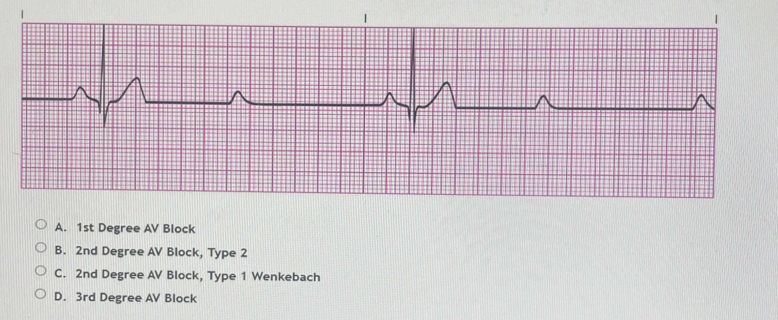 A. 1st Degree AV BlockB. 2nd Degree AV Block, Type