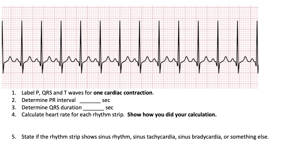 Solved If an electrocardiogram shows evidence of atrial | Chegg.com