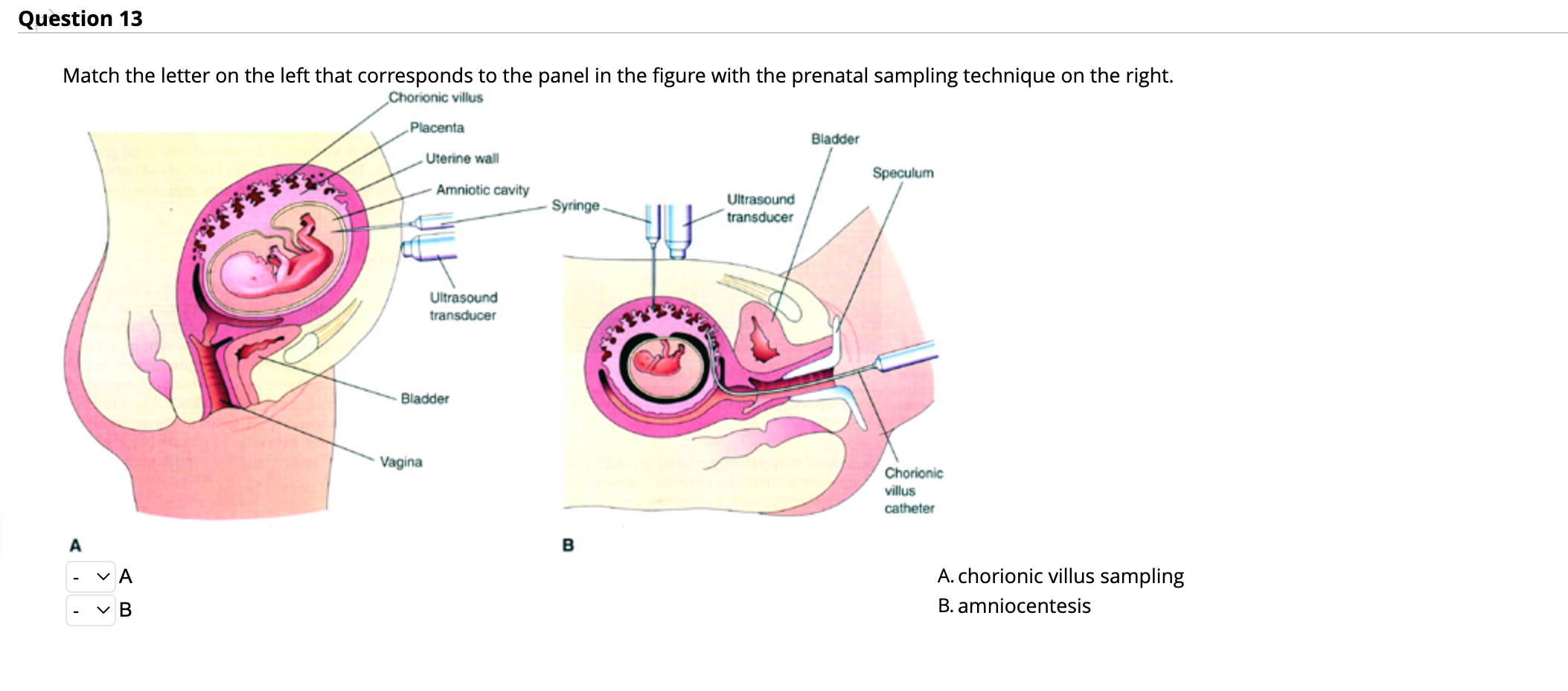Chorionic Villus Sampling Diagram