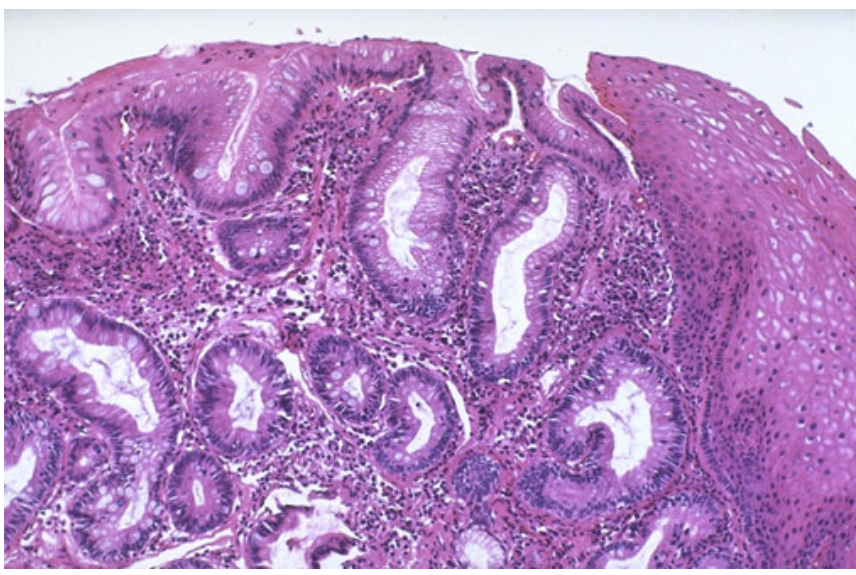 solved-the-patient-is-a-50-year-old-male-with-a-pmhx-of-gerd-chegg