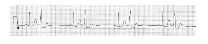 Solved Looking at this ECG below what is abnormal and what | Chegg.com