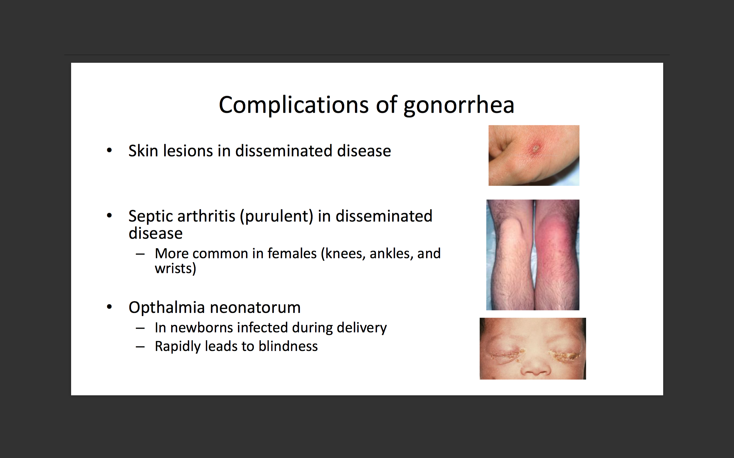 Gonorrhea Untreated