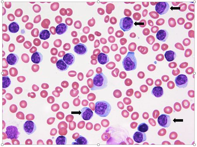 Solved What is unusual about this blood smear? What are the | Chegg.com