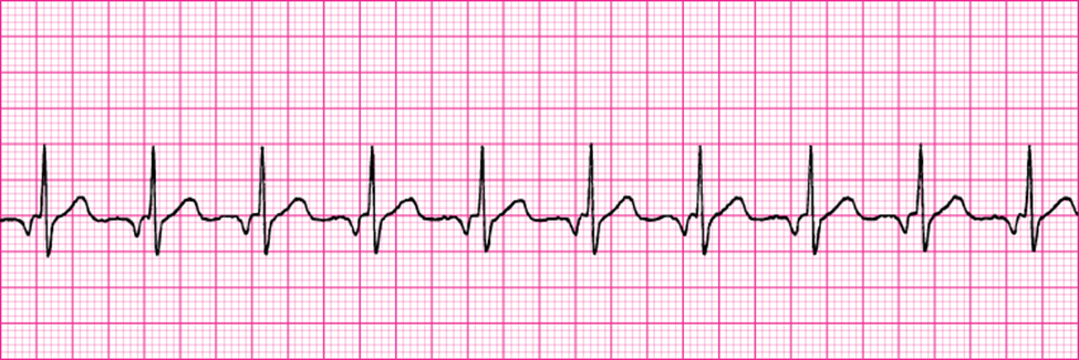 Solved Atrial Fibrillation (AFib)Accelerated Junctional | Chegg.com