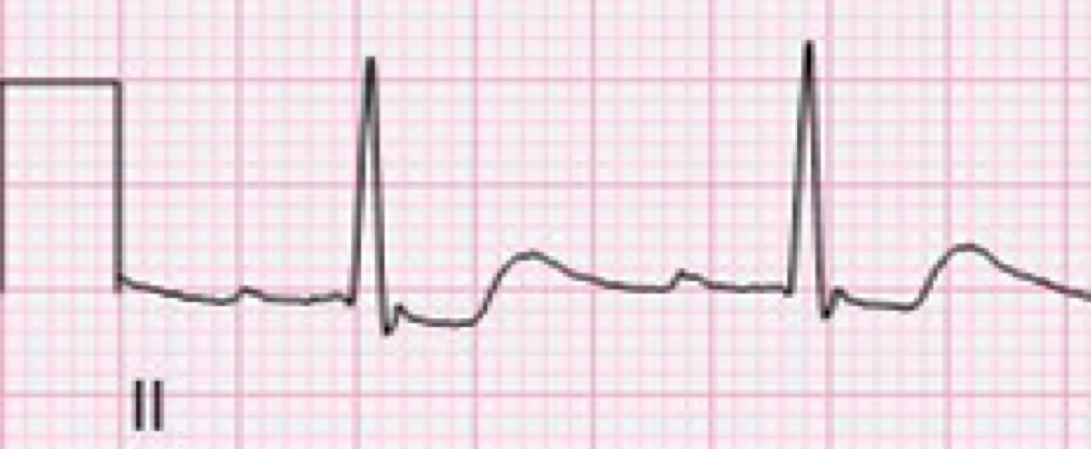 Solved 5. For each ECG strip: Calculate HR (show | Chegg.com