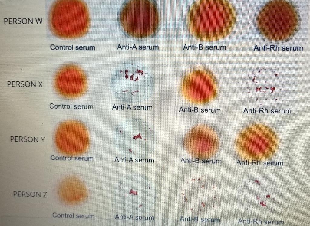 Solved Match The Blood Typing Results Below To The Correct | Chegg.com