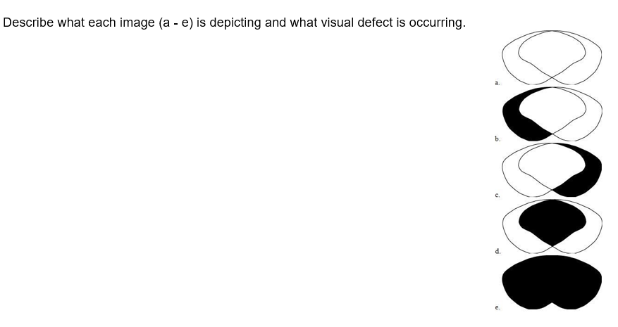 solved-1-2-please-draw-what-damage-to-the-left-optic-chegg