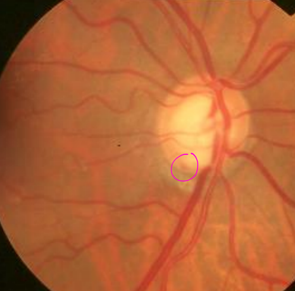 Peripapillary Atrophy Vs Scleral Crescent