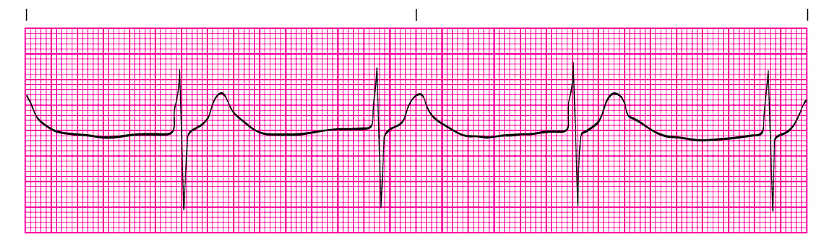 Solved What is the interpretation of these EKG | Chegg.com