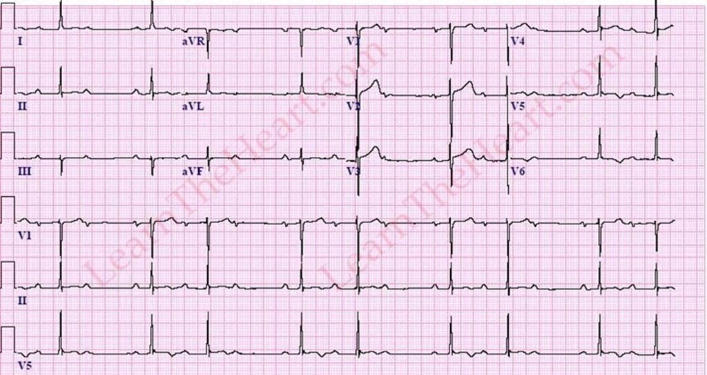 Solved Indicate the abnormalities you see (i.e., ST segment | Chegg.com