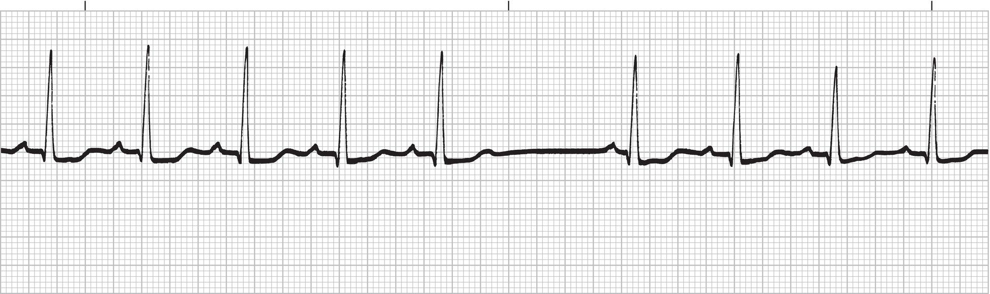 Solved Are there P waves? Is there a P wave for each | Chegg.com