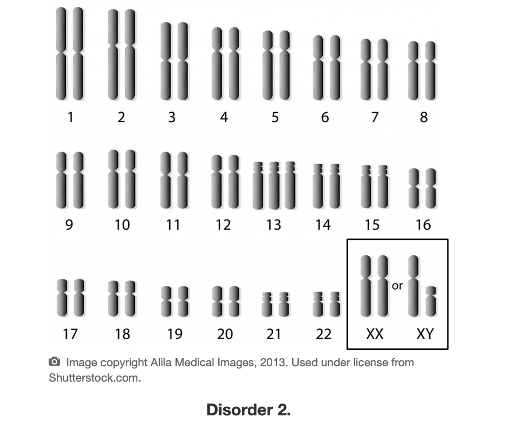 Трипло х. Синдром Патау трисомия по 13 хромосоме. Синдром Патау трисомия по 13 хромосоме кариотип. Синдром Патау кариотип. Синдром Патау трисомия хромосомы 13.