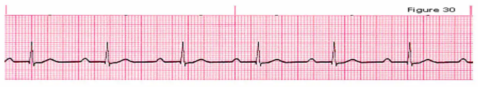 Solved a. Normal sinus rhythm f. 2nd degree AV Block Type 1 | Chegg.com