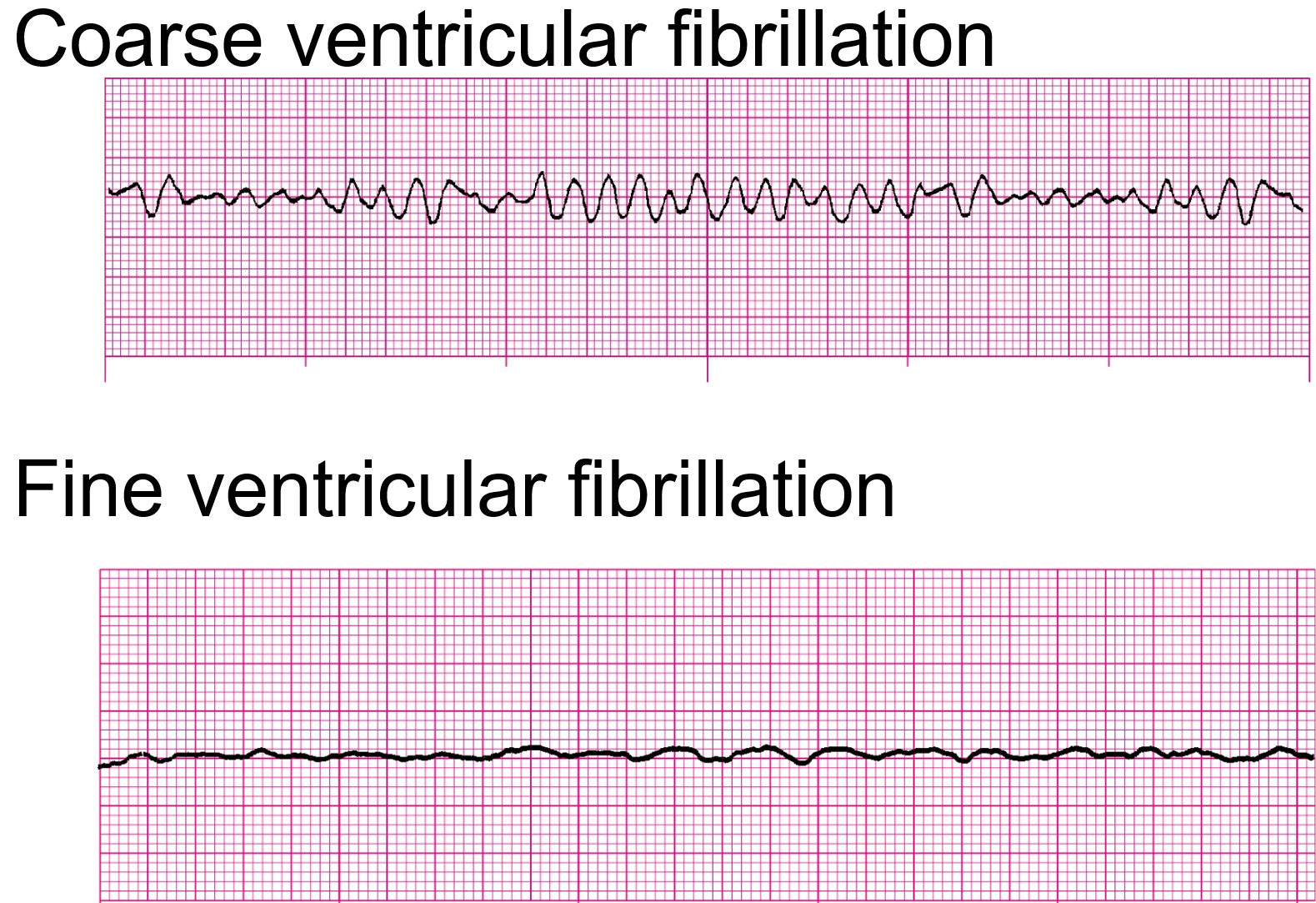 fine ventricular fibrillation vs coarse ventricular fibrillation