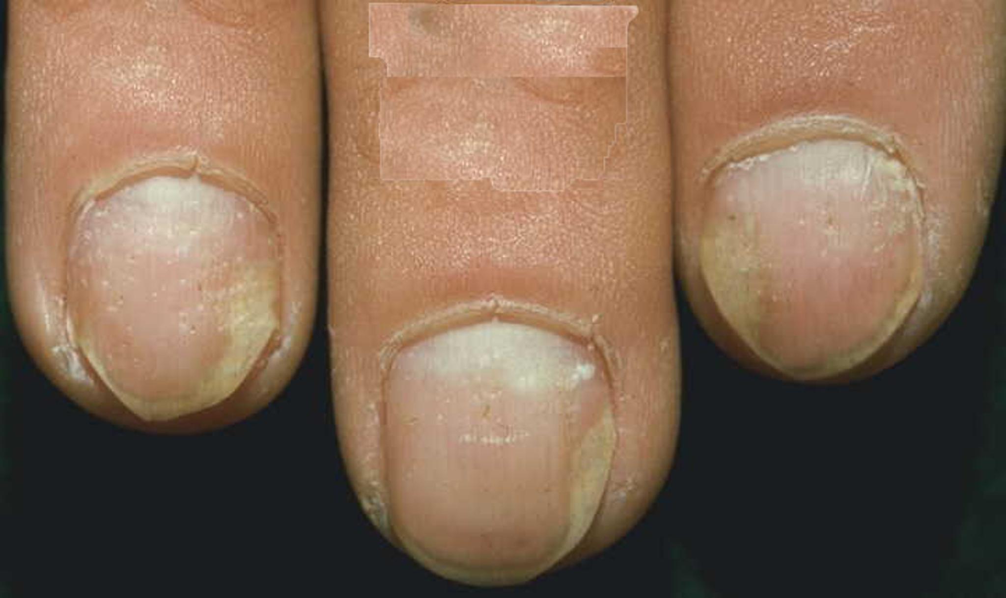 Nail conditions Flashcards 