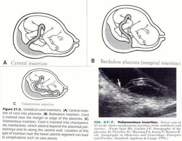 battledore placenta
