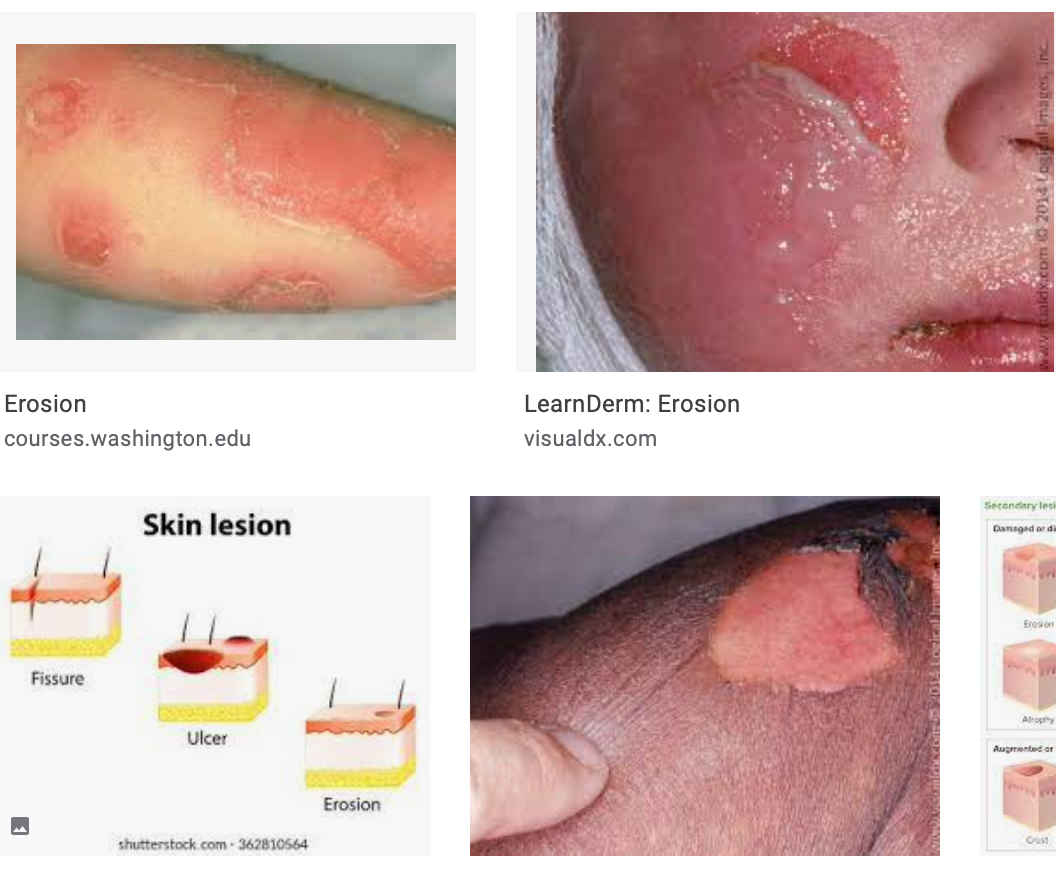 erosion skin lesion