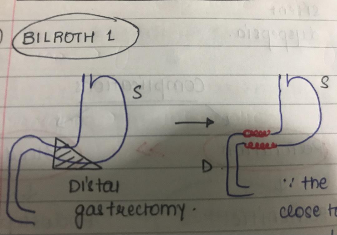 polya gastrectomy