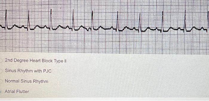 Solved 2nd Degree Heart Block Type II Sinus Rhythm with PJC | Chegg.com