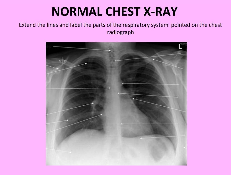 normal chest x ray labeled